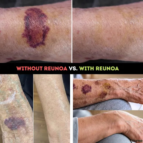 Reunoa